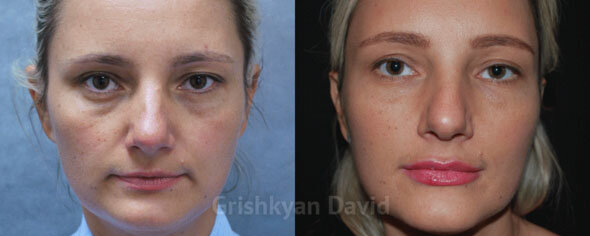 Липофилинг лица после сильного похудения фото до и после. Фото с сайта Д.Р. Гришкяна. Имеются противопоказания, требуется консультация специалиста