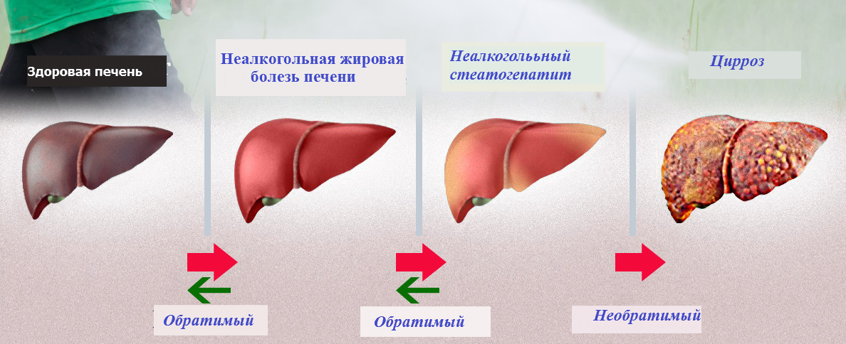 Неалкогольный стеатогепатит может называться и жировым гепатозом. На картинке хоть и не показано, но вторая и третья печени значительно увеличены по сравнению с первой. Фото взято с источника: https://goo.su/CByco0M 