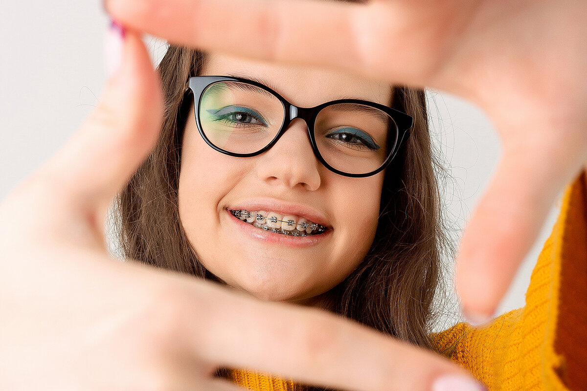 Брекет-система