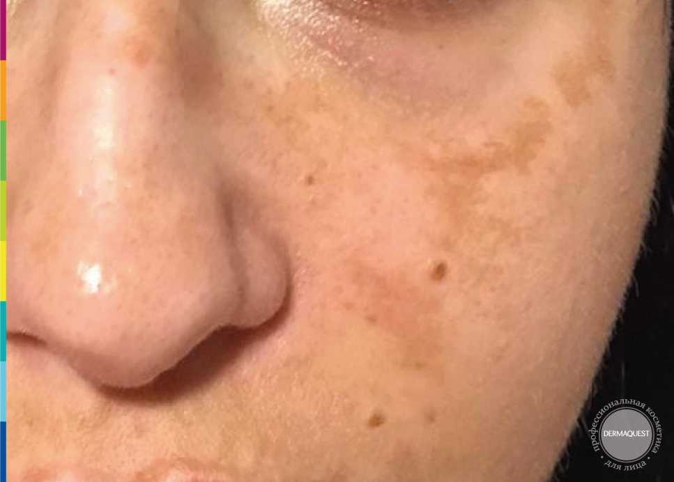 Елены, 32 года, пигментация на лице