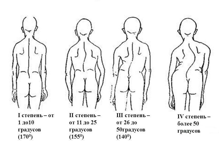 Сколиоз у детей и подростков