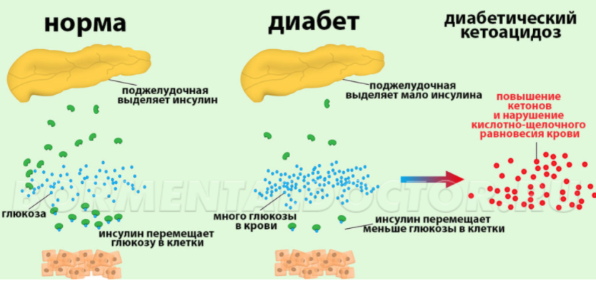 Гипергликемия и диабетический кетоацидоз