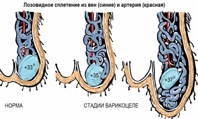 Варикозное расширение вен семенного канатика на