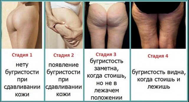 Стадии целлюлита 