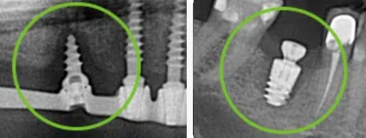 Периимплантит