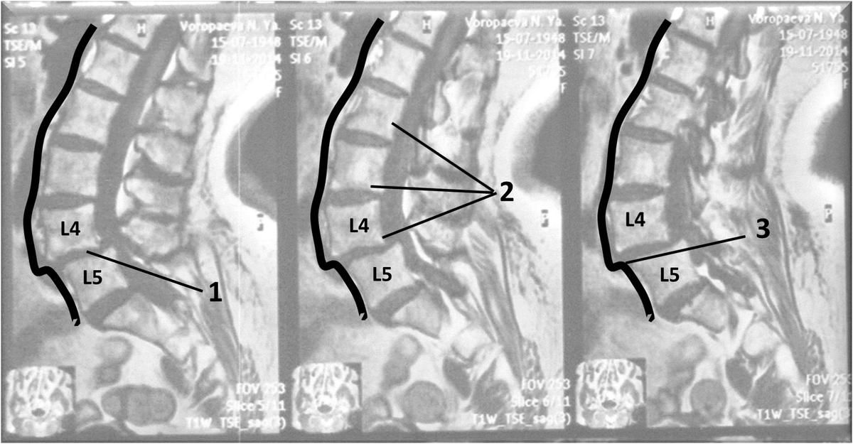 Снимок позвоночника с передним спондилолистезом ("антелистезом") прорисовка. собственные наблюдения автора