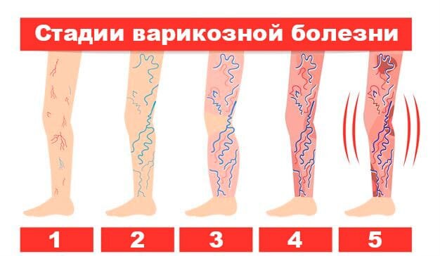Различают несколько стадий заболевания. Помимо снижения качества жизни, варикоз может привести к операции, ампутации и даже смерти