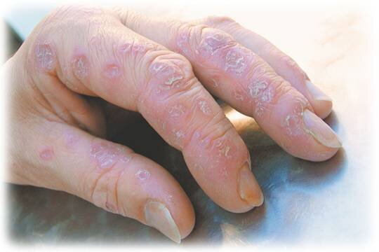    Зудящая проблема