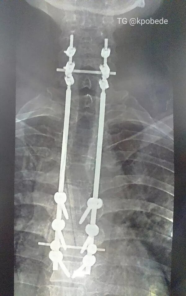 Титановая пластина добавила воинской выправки, шутит Влад. © Фото : из личного архива Влада Филина