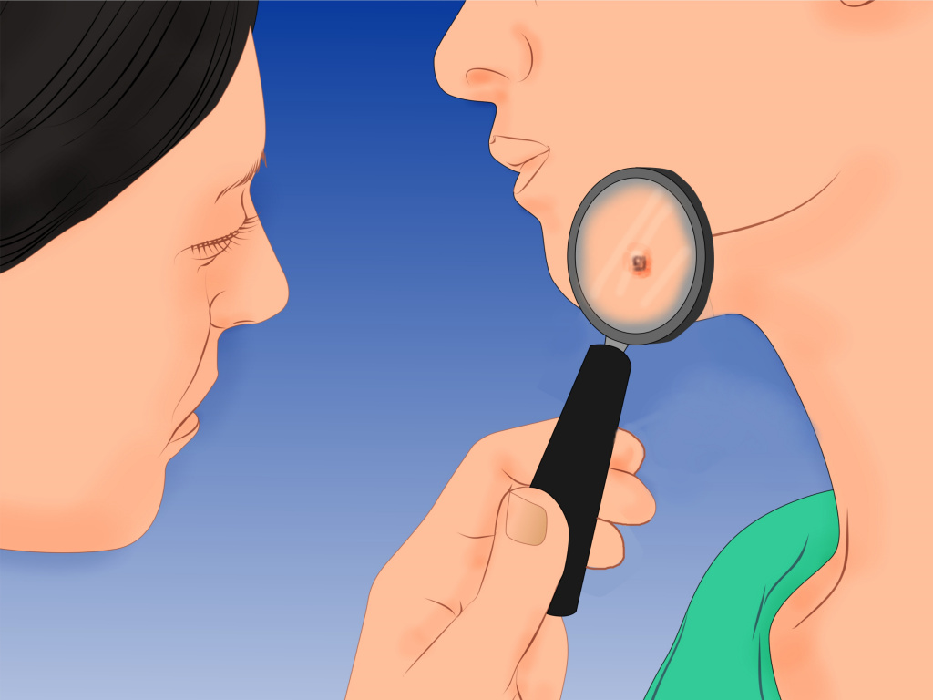 A 17-year-old woman with Wegener granulomatosis and a severe saddle... Download 