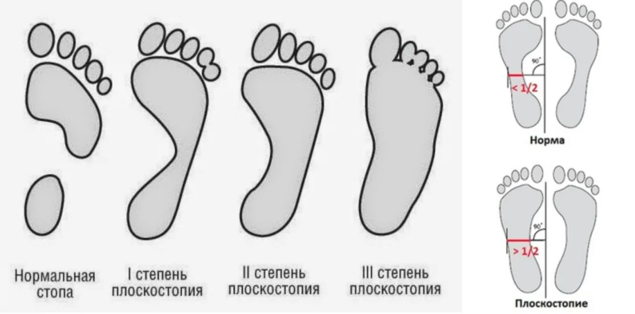 Стопа ребенка 3 года. Схема стопы плоскостопие. Плоскостопие 1 2 3 степени. Степени продольного и поперечного плоскостопия. Поперечное плоскостопие 2 степени.