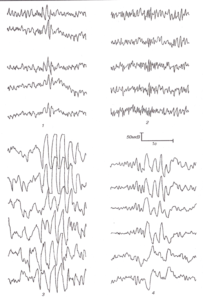 Условно-эпилептиформные феномены: вспышки заостренных α-(1) и β- (2) колебаний; вспышки θ- (3) и полифазных θ- и δ-колебаний (4).