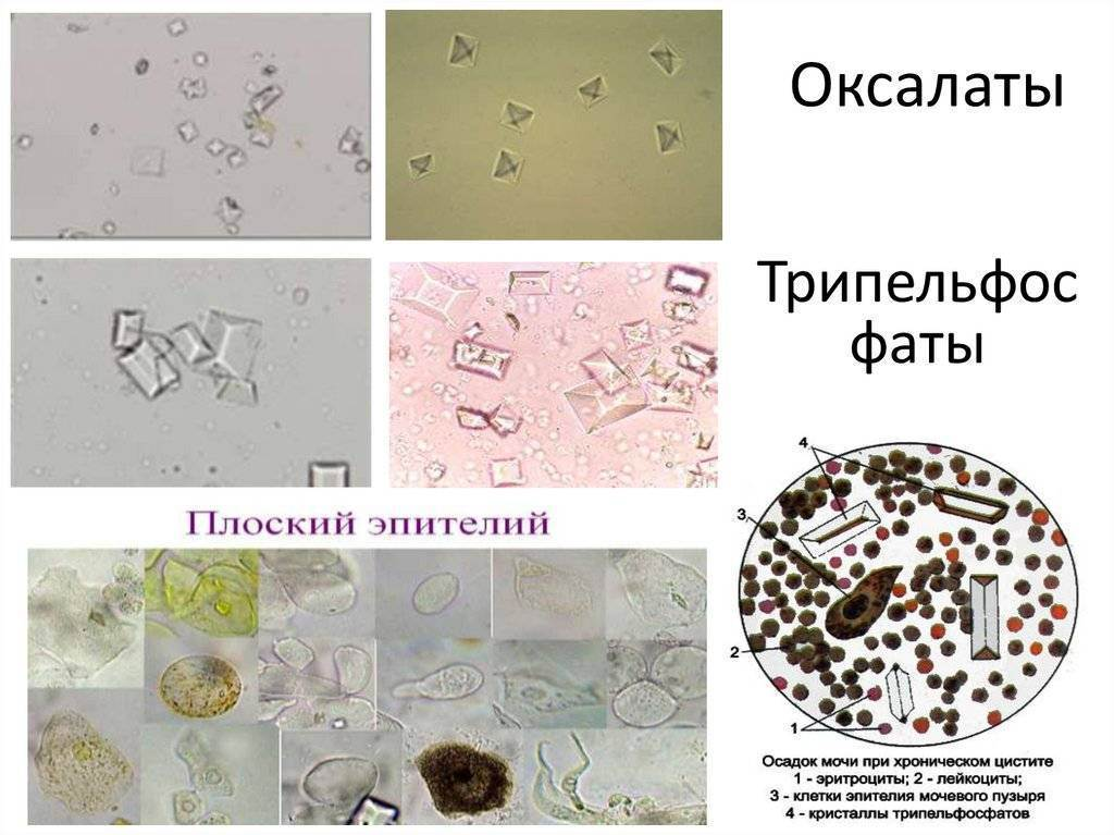 Соли в моче. Норма и патология