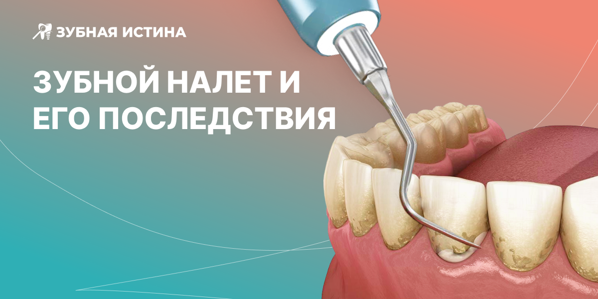 Удаления зубного налёта должно являться частью ежедневного гигиенического ухода за полостью рта.