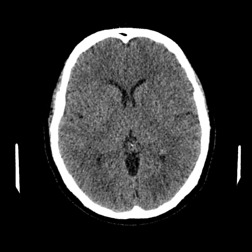 КТ головного мозга
