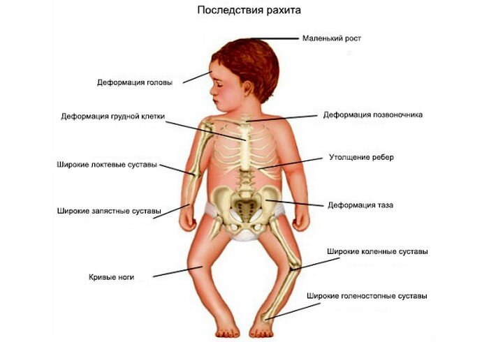 Рахитные дети как выглядят Этого витамина не хватает большинству людей Доктор Жизнь Дзен