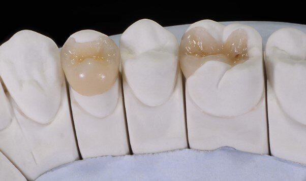 Несъемные зубные протезы: какие они бывают? | Стоматология ROOTT | Дзен