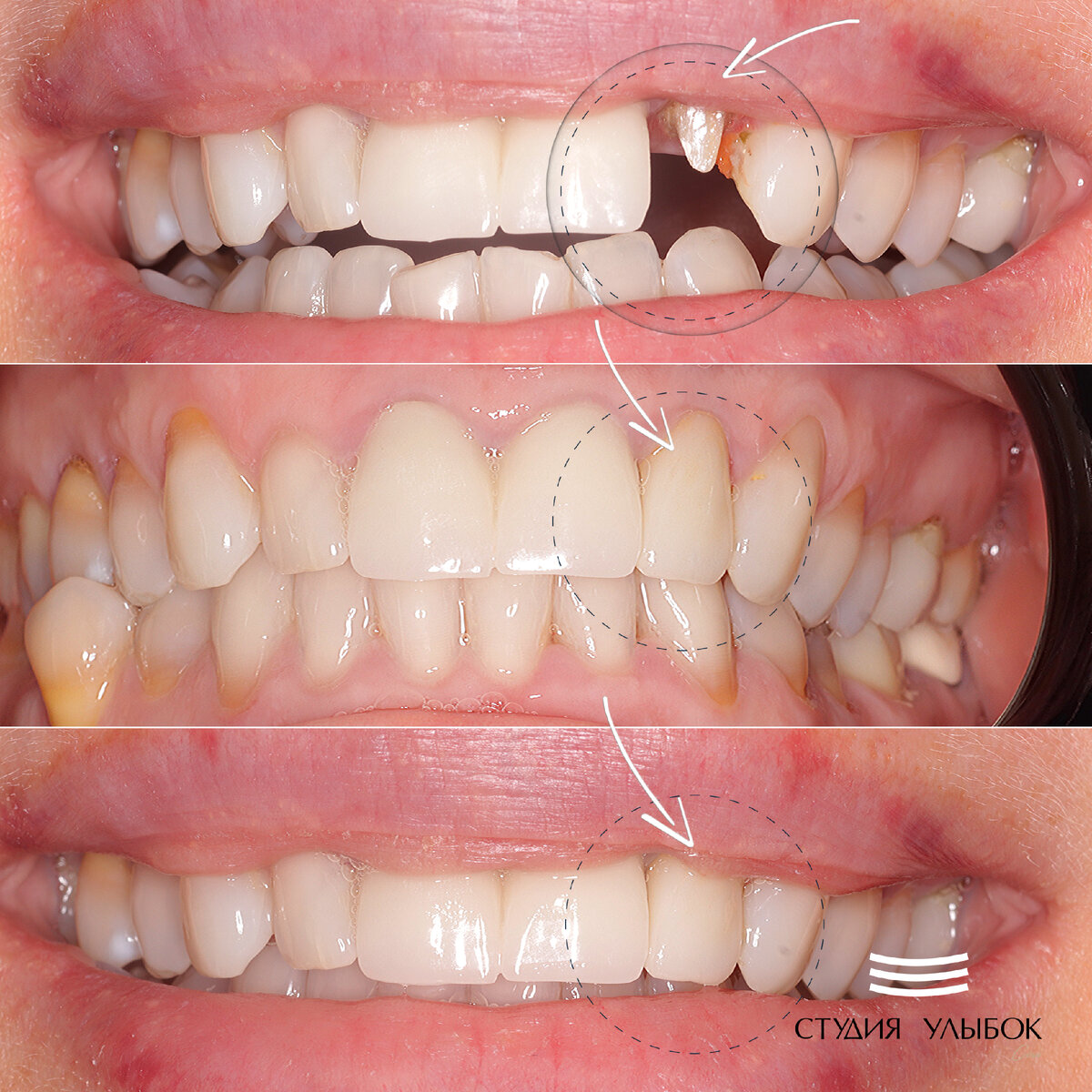 Процесс установки керамической коронки на сколе зуба.