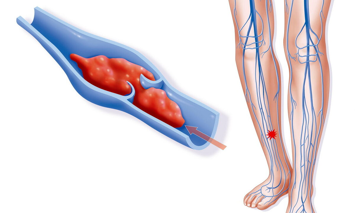 Как выглядит тромб вен. Острый тромбоз глубоких вен клиника. Тромбоз поверхностных вен клиника. Тромбофлебит глубоких вен синдромы.