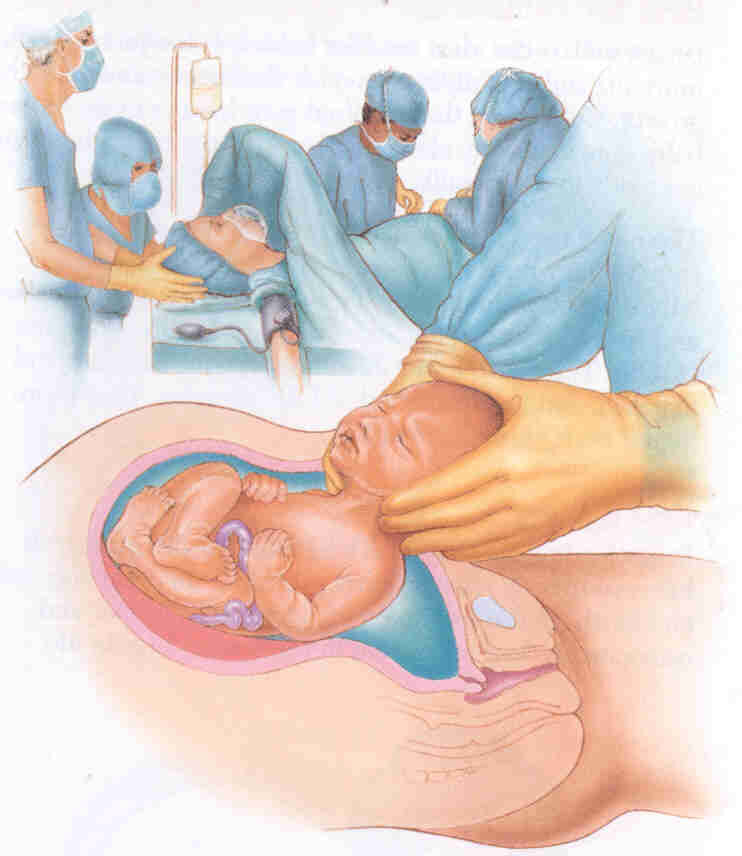 Прогнозирование успешных вагинальных родов после кесарева сечения
