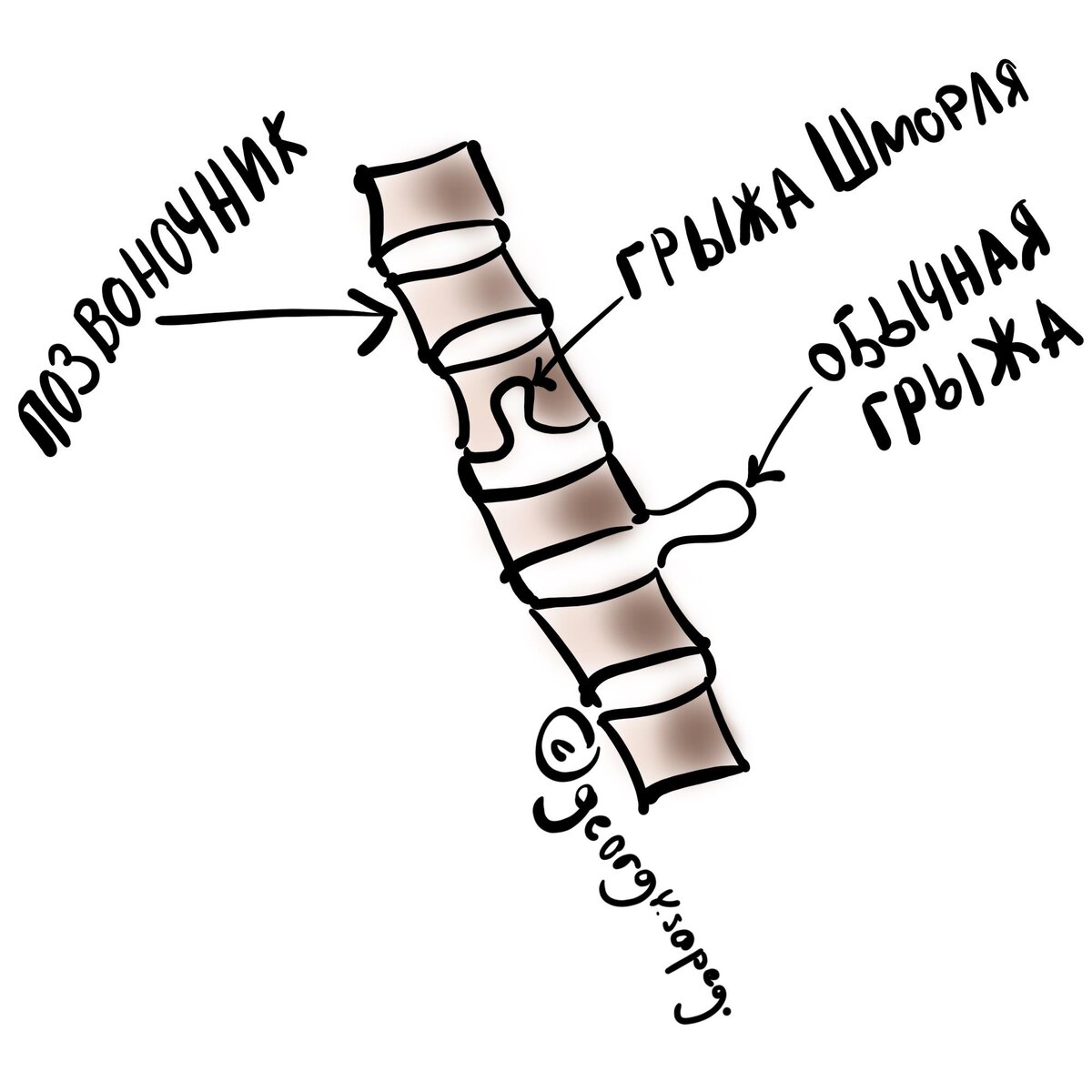 Грыжа Шморля. Что это за зверь у нас в позвоночнике | Для пациентов | Дзен