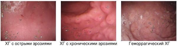 Гастрит эрозивный – статьи о здоровье