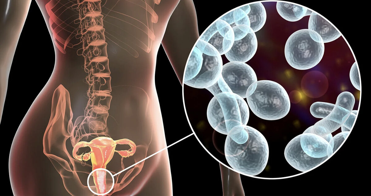 Причины молочницы