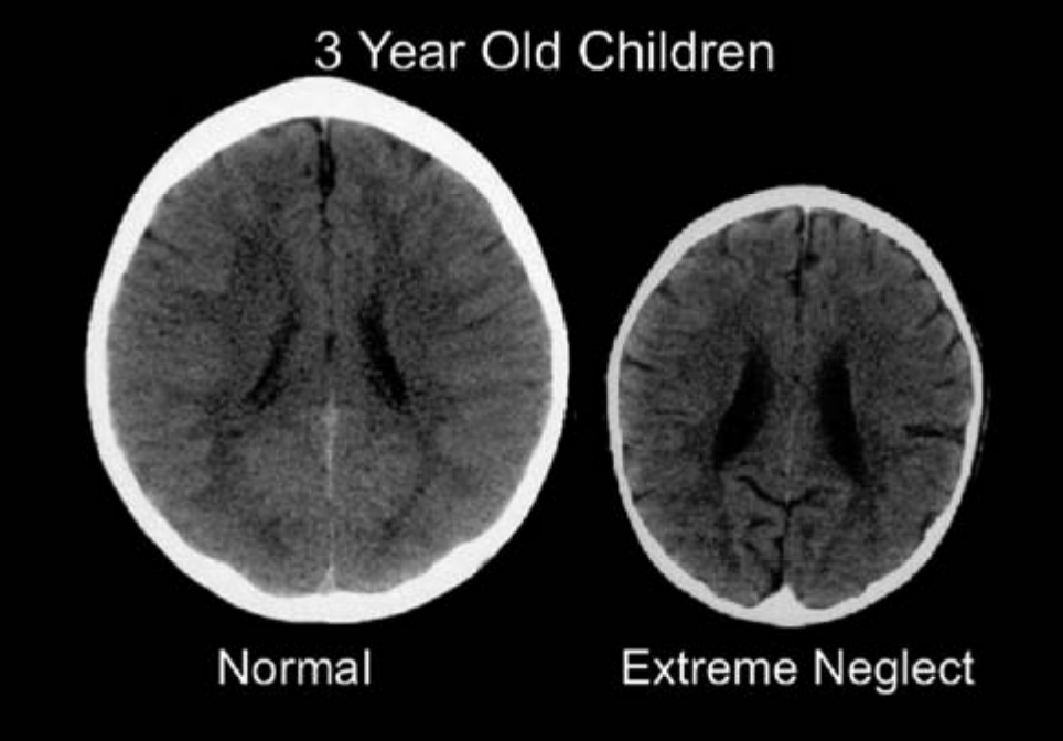 Компьютерная томография слева сделана здоровому 3-летнему ребенку со средним размером головы. Изображение справа взято из серии фотографий 3-летних детей, перенесших тяжелую сенсорную депривацию в раннем детстве. Мозг справа значительно меньше среднего и имеет другие отклонения, свидетельствующие о ненормальном развитии мозга.
