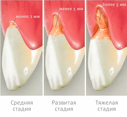 Стадии клиновидного дефекта