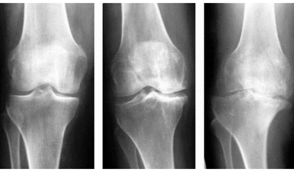 Некроз мыщелки. Kellgren Lawrence артроз коленного. Остеоартроз (деформирующий остеоартроз). Остеоартроз коленного сустава рентген. Артрозо-артрит коленного сустава рентген.