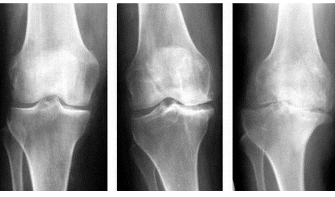 Гонартроз коленного сустава степени лечение. Артропатия коленного сустава рентген. Остеоартроз коленного сустава 1 рентген. Деформирующий остеоартроз коленного сустава рентген. Деформирующий артроз коленного сустава рентген.