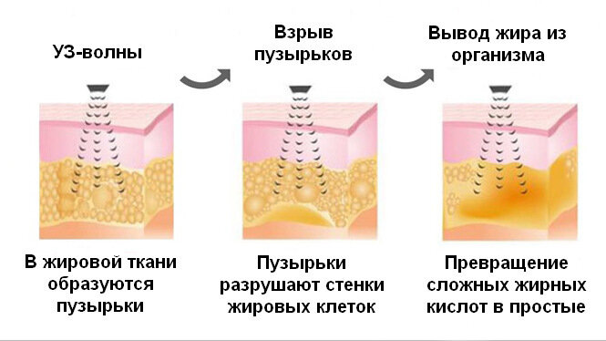 Рисунок 2 - Принцип работы УЗ кавитации.