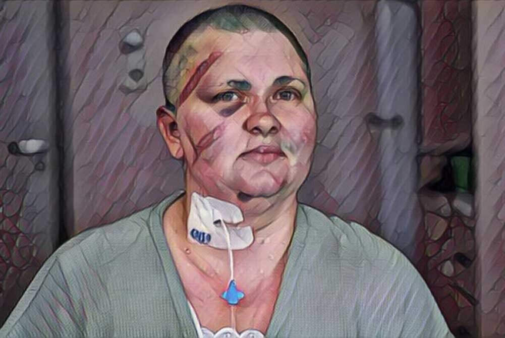 Елена Милашина после нападения 4 июля 2023 года