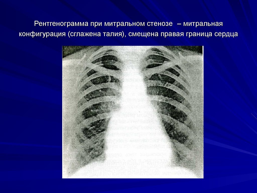 Митральный стеноз