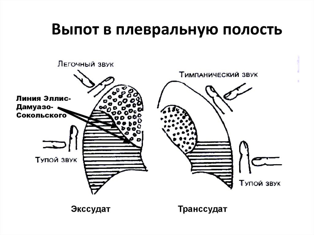 Признаки плеврального выпота. Экссудативный плеврит схема. Аускультативный признак плеврального выпота:. Выпот в плевральной полости. Двусторонний малый плевральный выпот.