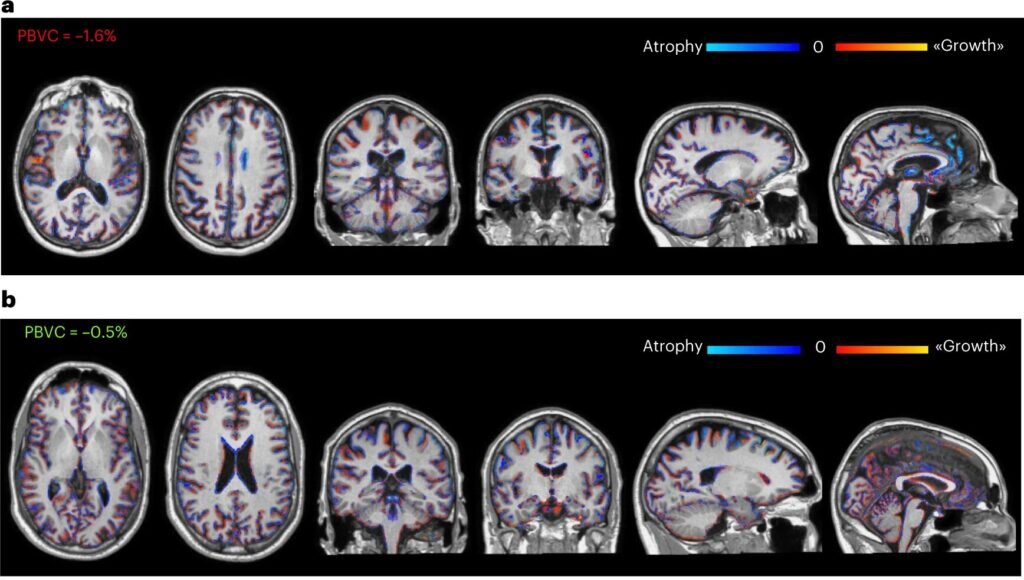    МРТ головного мозга с отмеченными цветными областями атрофии (синий) и роста (красный) серого вещества головного мозга через 2 года после трансплантации нейрональных стволовых клеток-предшественников у двух репрезентативных пациентов, получавших низкую дозу (а) и высокую дозу (б) стволовых клеток / © Genchi A. et al, Nature Medicine, 2023