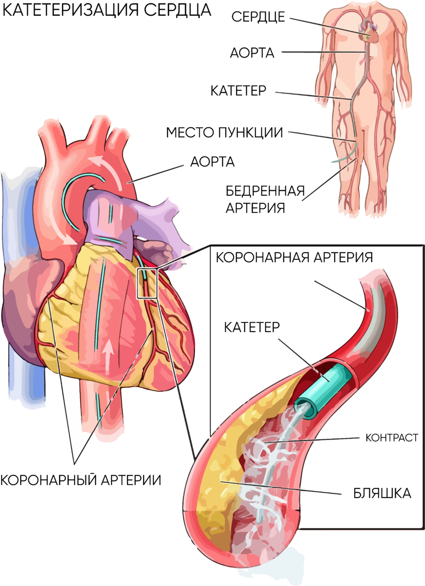 Что такое катетеризация сердца? | Кардиохирург Нургалиев Рахим Ринатович |  Дзен