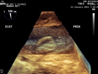    УЗ-пластырь может сканировать сердце в реальном времени