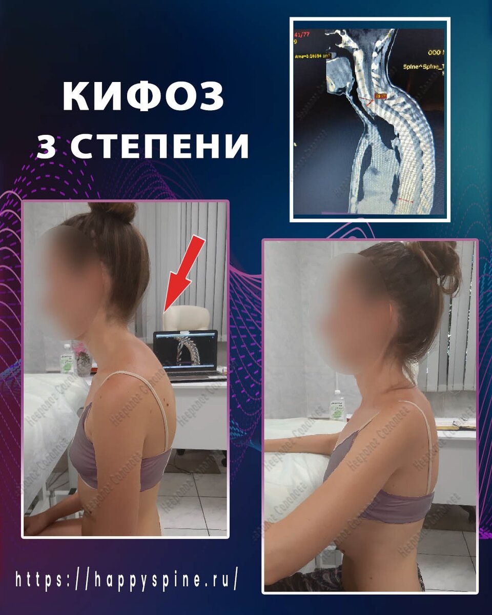 Кифоз 3 степени