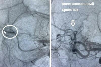    Тромб, перекрывший артерию головного мозга © Пресс-служба Министерства здравоохранения Московской области