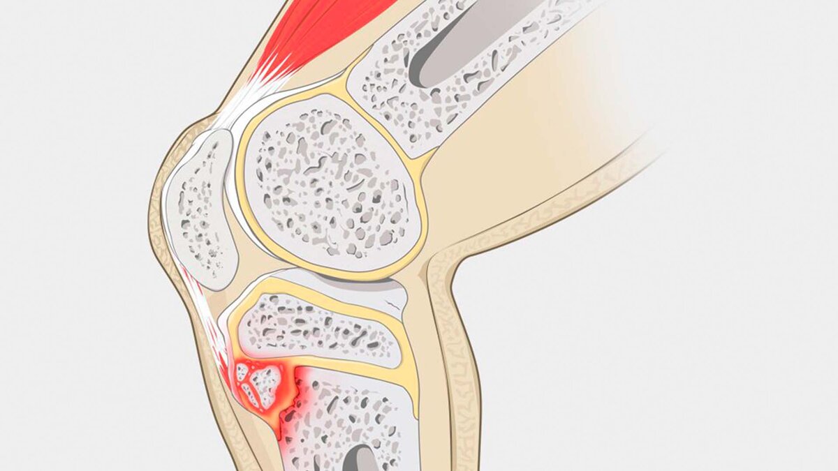 Болющий. Осгуд Шляттера болезнь коленного сустава. Болезнь Шляттера коленного сустава. Болезнь Осгуда-Шлаттера у подростков что это. Болезнь Осгуда-Шлаттера колено.