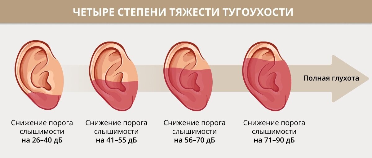 Вот два уха с обеих сторон. 4 Степени нарушения слуха. Легкая степень тугоухости. Тугоухость 3 степени. Умеренная степень тугоухости.