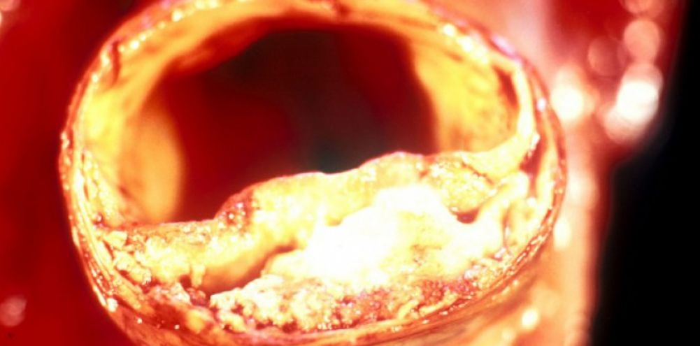 Атеросклеротическая бляшка суживает (стенозирует) просвет сосуда