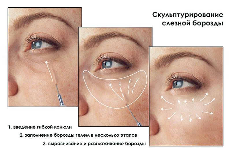 Как убрать носослезную борозду: косметологические методы коррекции