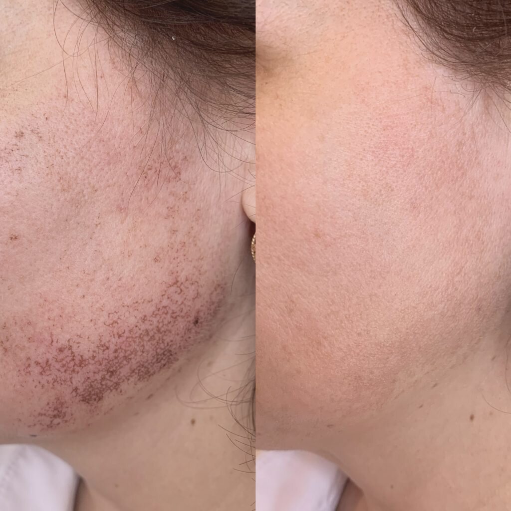 Фототерапия пигментации