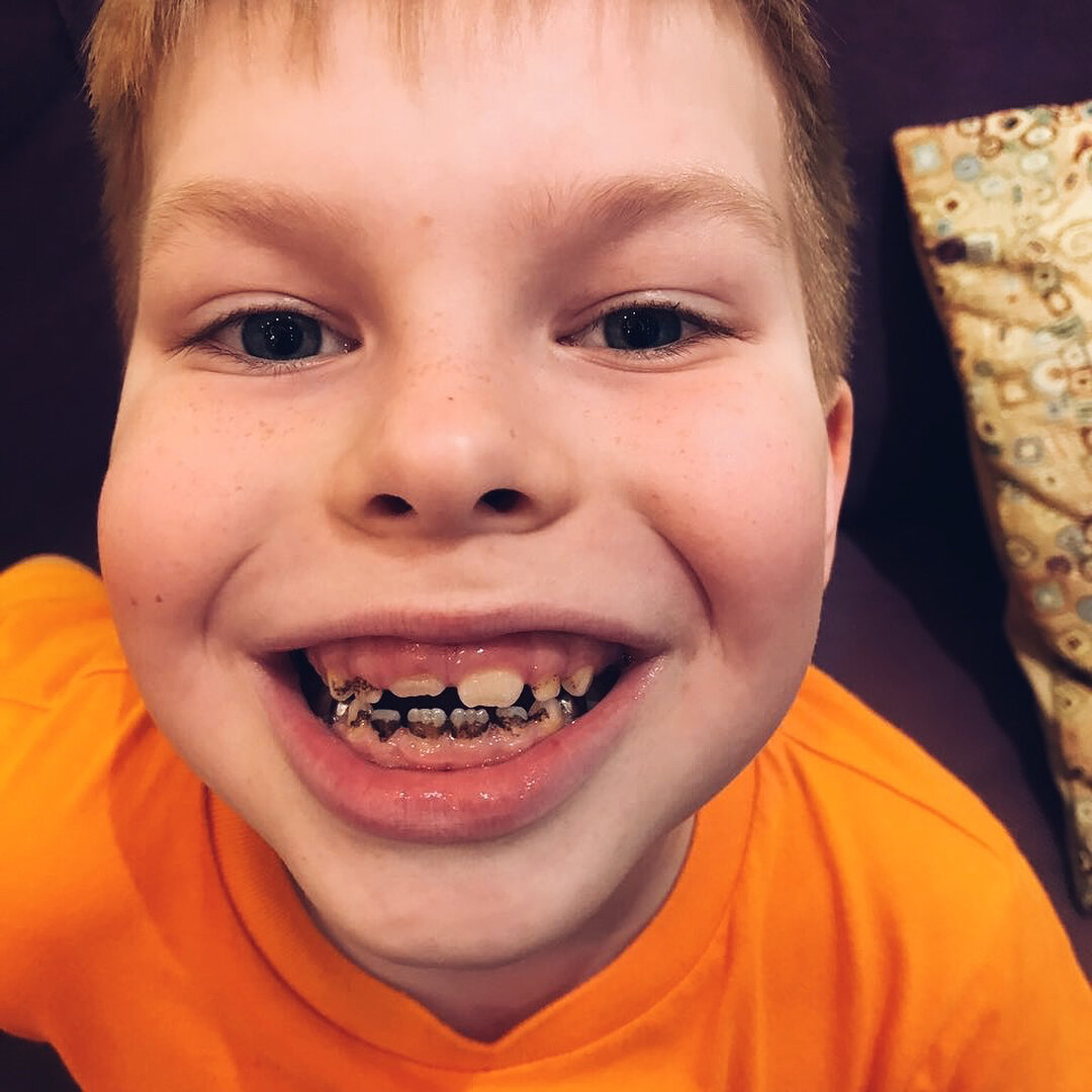 Тот самый налет Пристли на зубах у пациента. Источник https://www.instagram.com/dental.fantasy/