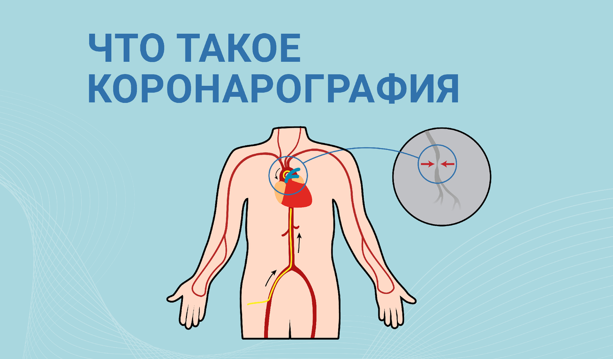 Что такое коронарография? Как и зачем её проводят? | Сервье Россия ...