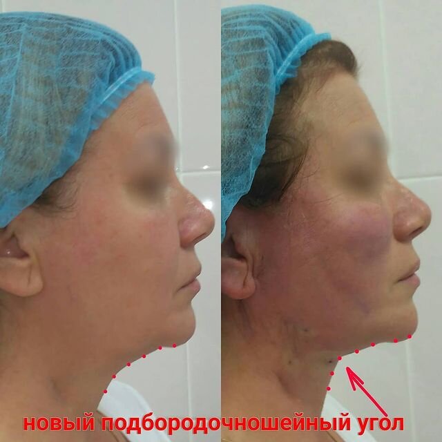 На фото пациентка Данилы Лупина. Имеются противопоказания, необходима консультация специалиста.