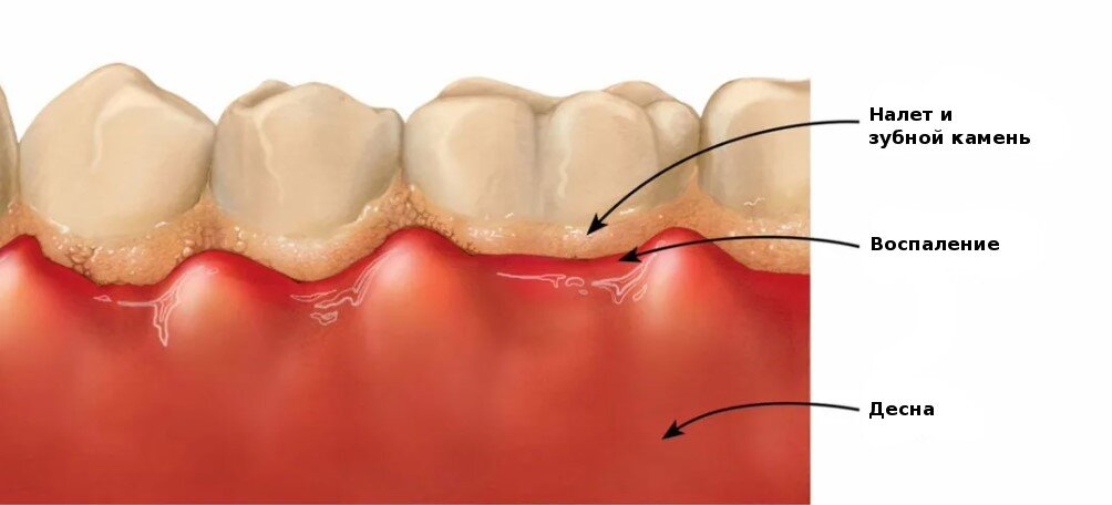 Гингивит десен