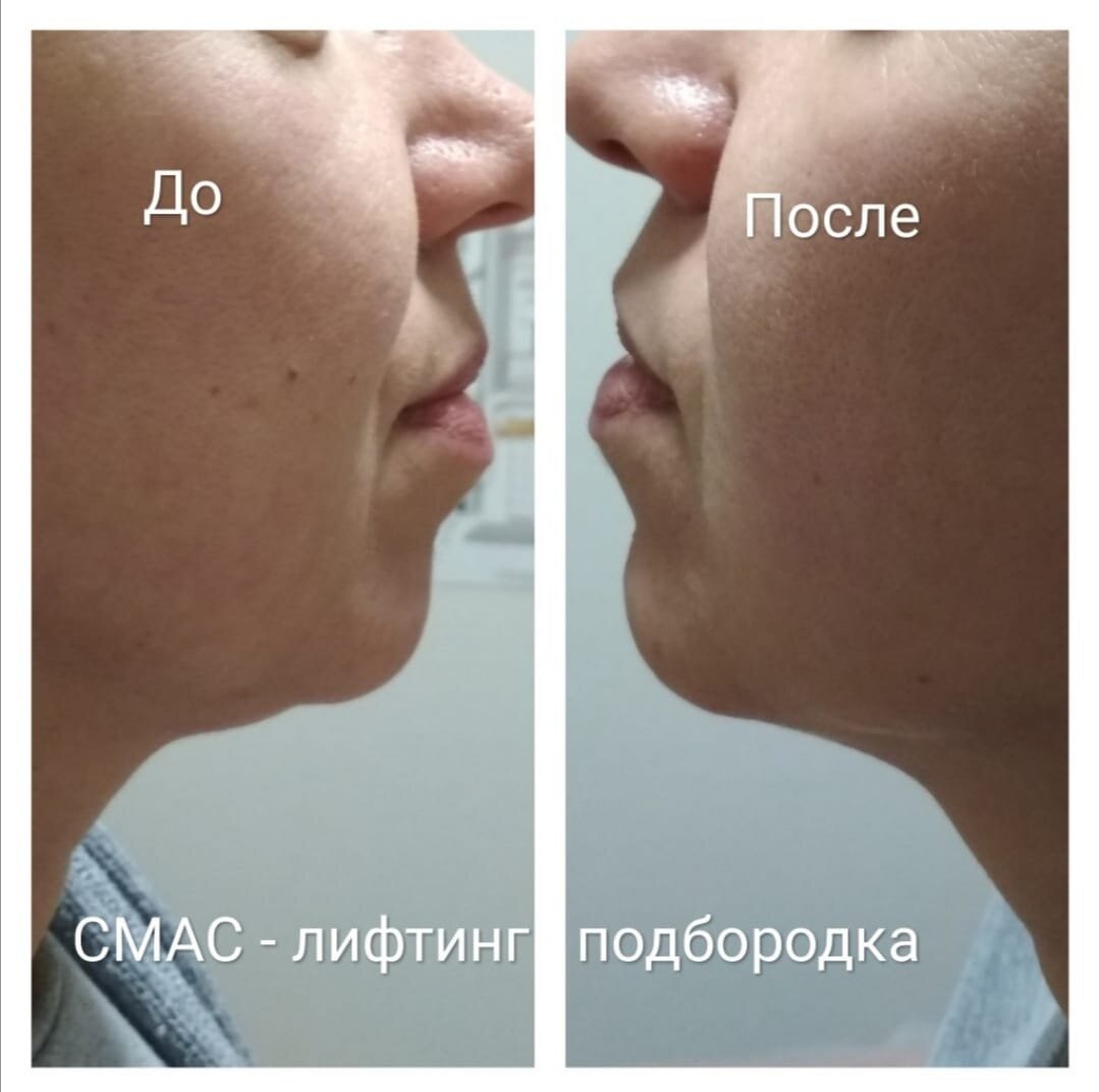 Фото клиента Марии Котовой. Не забывайте проконсультироваться со специалистом, имеются противопоказания